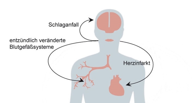 Grafik: Zusammenhang Mund- und Herzgesundheit